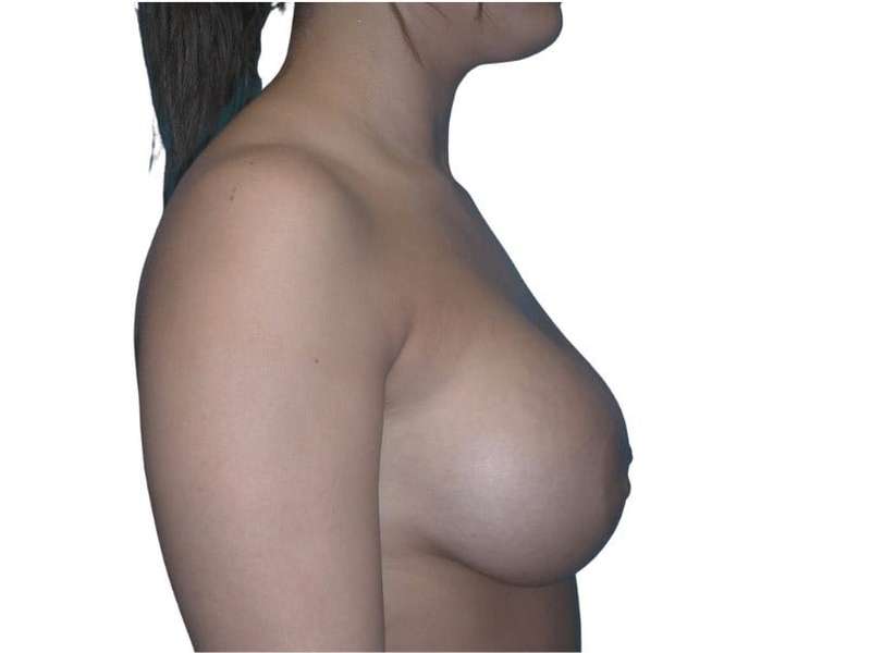 Breast Augmentation Before & After Patient #670