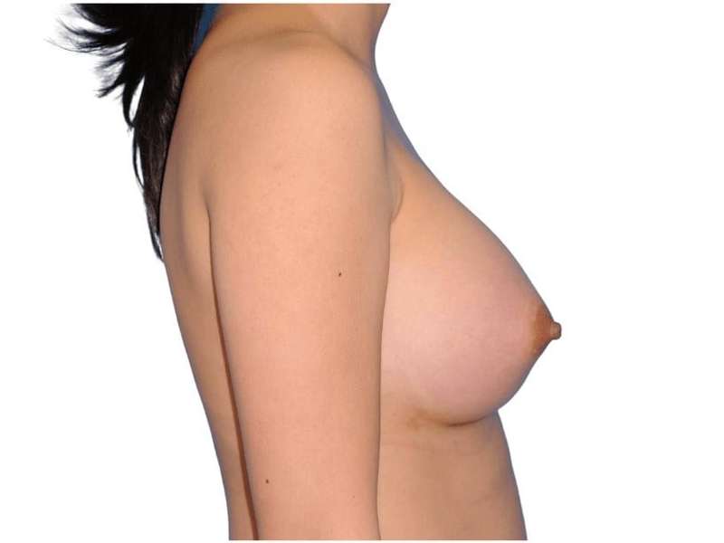 Breast Augmentation Before & After Patient #679