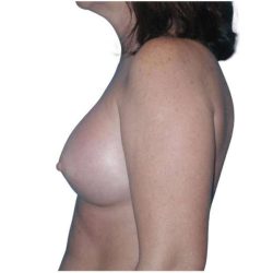 Breast Augmentation Before & After Patient #686