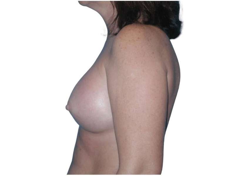 Breast Augmentation Before & After Patient #686