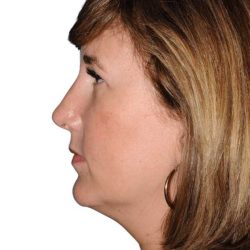 Rhinoplasty Before & After Patient #418