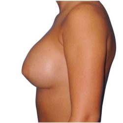 Breast Augmentation Before & After Patient #693