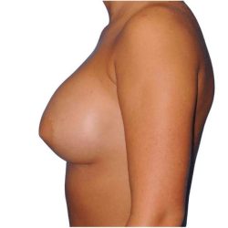 Breast Augmentation Before & After Patient #700