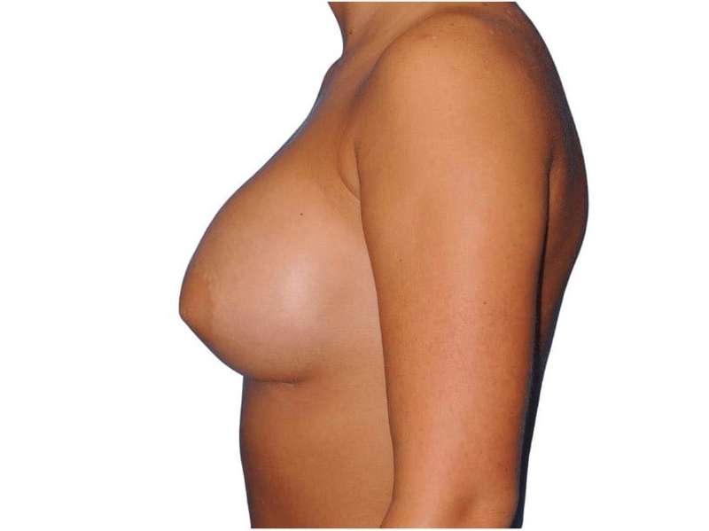 Breast Augmentation Before & After Patient #700