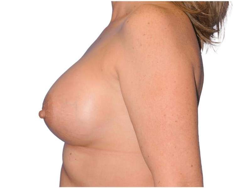Breast Augmentation Before & After Patient #714