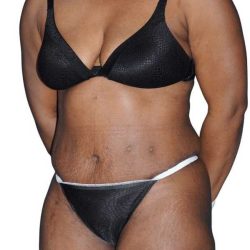 Tummy Tuck Before & After Patient #478