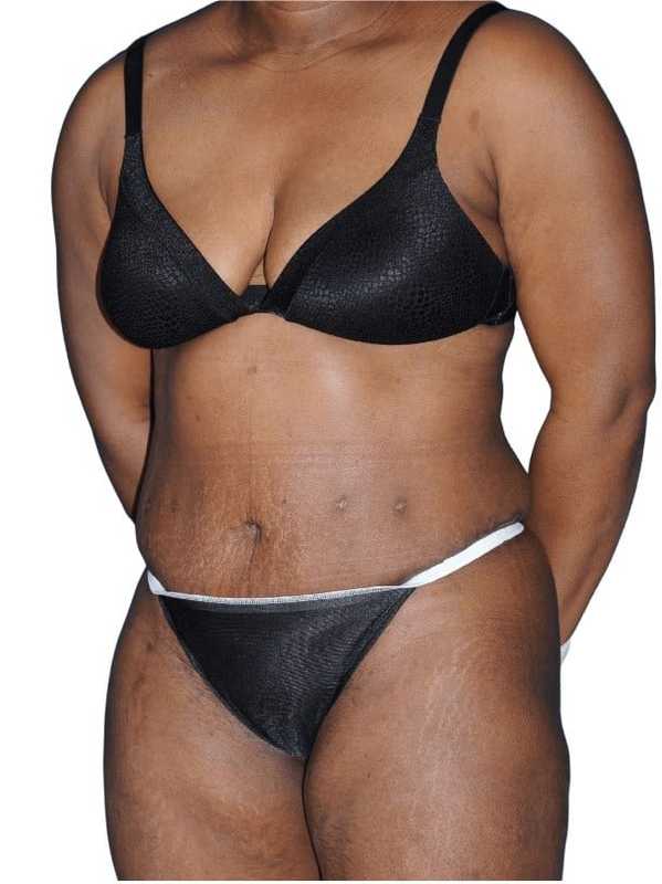 Tummy Tuck Before & After Patient #478