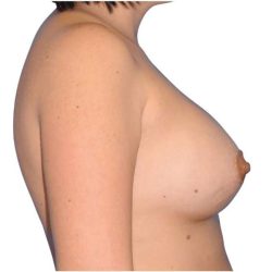 Breast Augmentation Before & After Patient #721