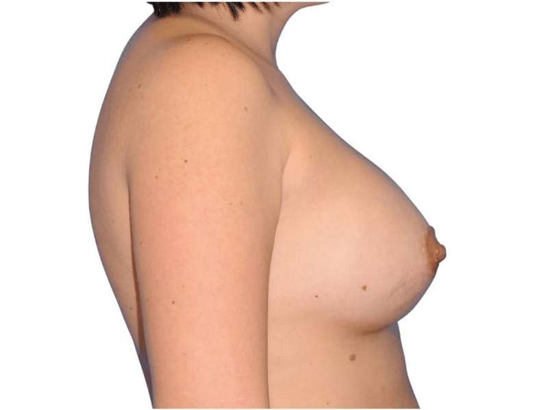 Breast Augmentation Before & After Patient #721