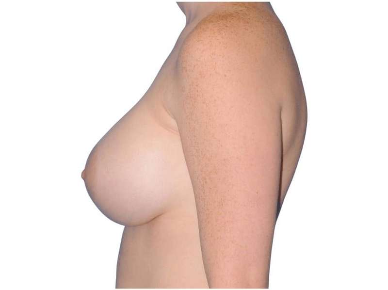 Breast Augmentation Before & After Patient #733