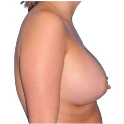 Breast Augmentation Before & After Patient #747