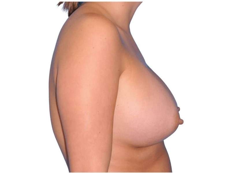 Breast Augmentation Before & After Patient #747