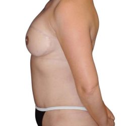 Breast Reconstruction Before & After Patient #805
