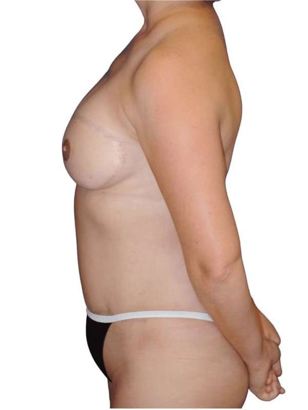 Breast Reconstruction Before & After Patient #805