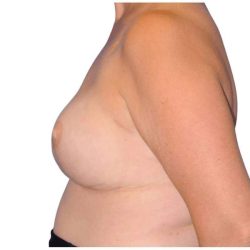 Breast Reconstruction Before & After Patient #828