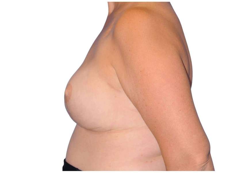 Breast Reconstruction Before & After Patient #828