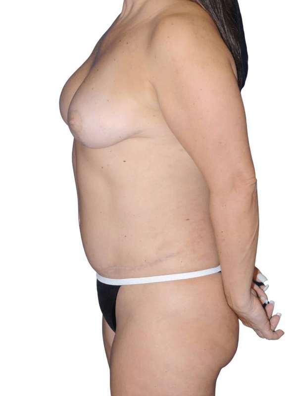 Breast Reconstruction Before & After Patient #866