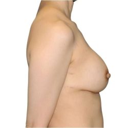 Breast Reconstruction Before & After Patient #880