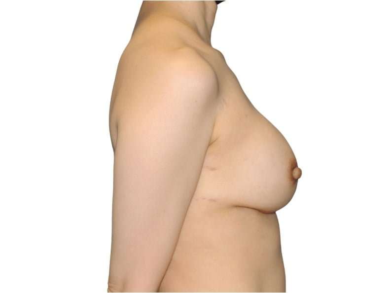Breast Reconstruction Before & After Patient #880