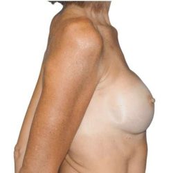 Breast Reconstruction Before & After Patient #891