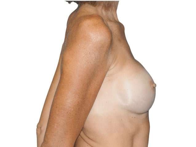 Breast Reconstruction Before & After Patient #891