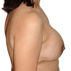 Breast Reconstruction Before & After Patient #898