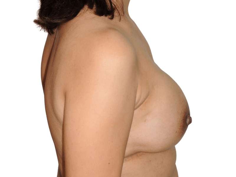 Breast Reconstruction Before & After Patient #898