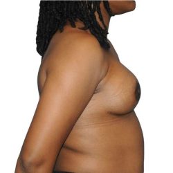 Breast Reconstruction Before & After Patient #905