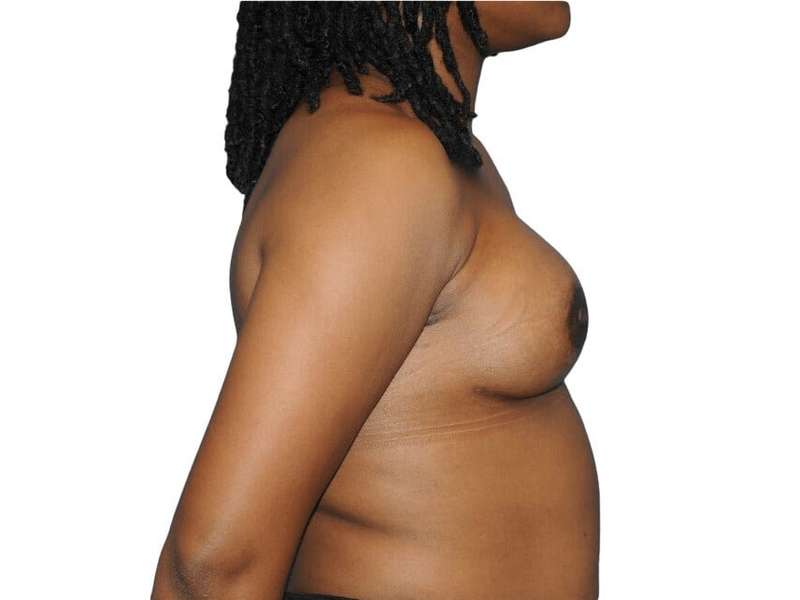 Breast Reconstruction Before & After Patient #905