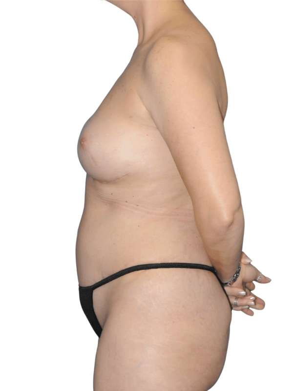 Breast Reconstruction Before & After Patient #923