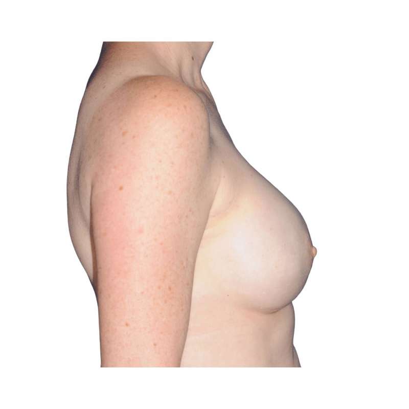 Breast Reconstruction Before & After Patient #930