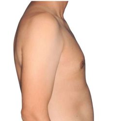 Gynecomastia Before & After Patient #515