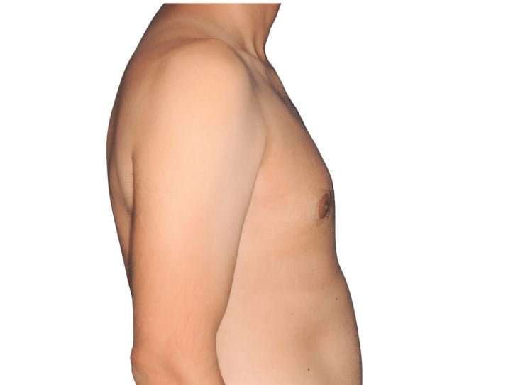 Gynecomastia Before & After Patient #515