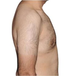 Gynecomastia Before & After Patient #525