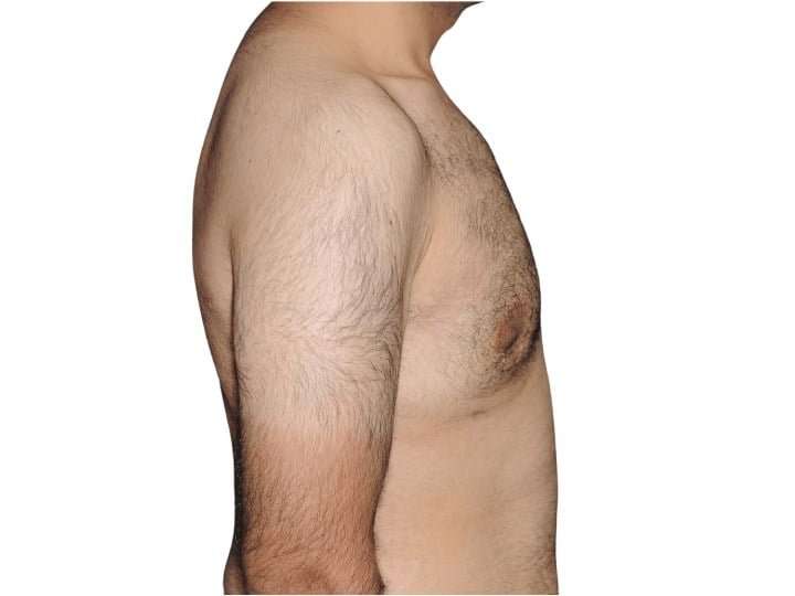 Gynecomastia Before & After Patient #525