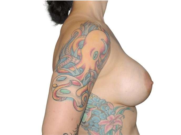 Breast Lift Before & After Patient #546