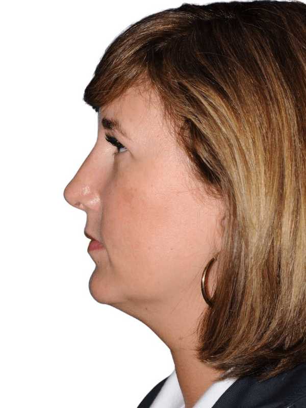 Rhinoplasty Before & After Patient #418
