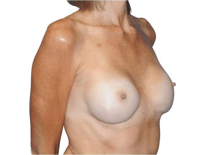 Breast Reconstruction Before & After Patient #891