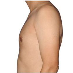 Gynecomastia Before & After Patient #515