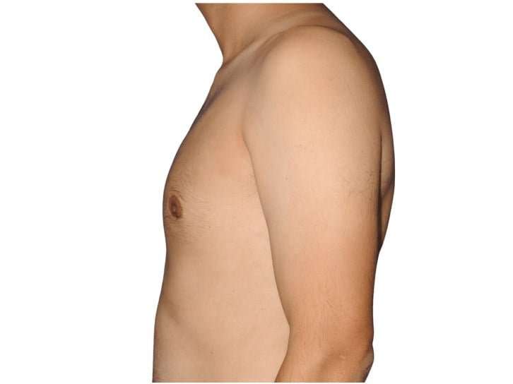 Gynecomastia Before & After Patient #515