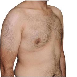 Gynecomastia Before & After Patient #525