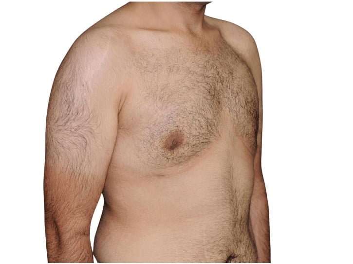 Gynecomastia Before & After Patient #525