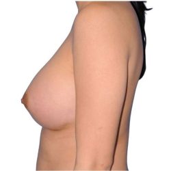Breast Augmentation Before & After Patient #679