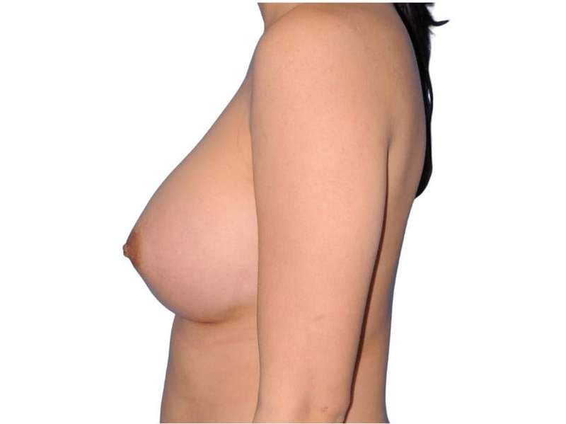 Breast Augmentation Before & After Patient #679