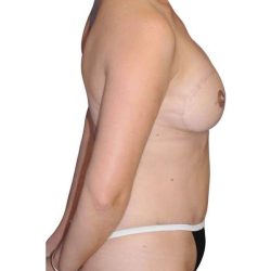 Breast Reconstruction Before & After Patient #805