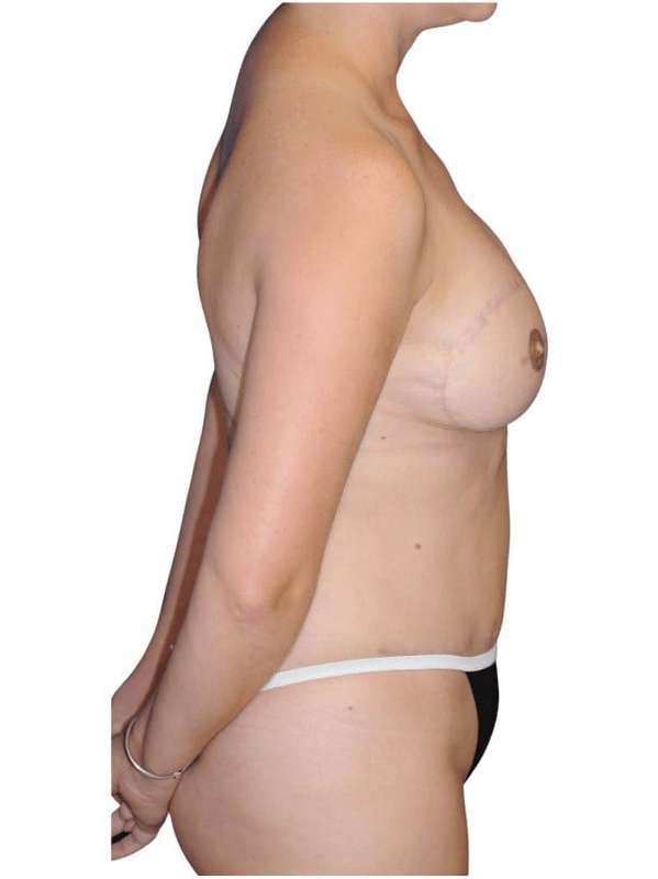 Breast Reconstruction Before & After Patient #805