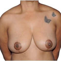 Mommy Makeover Before & After Patient #433