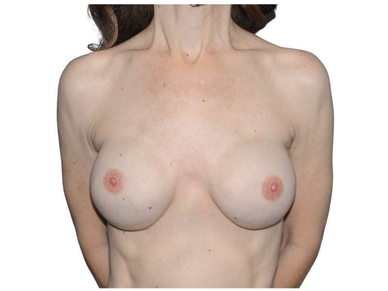 Breast Reconstruction Before & After Patient #821