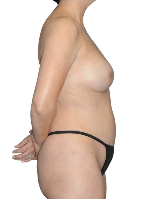 Breast Reconstruction Before & After Patient #923