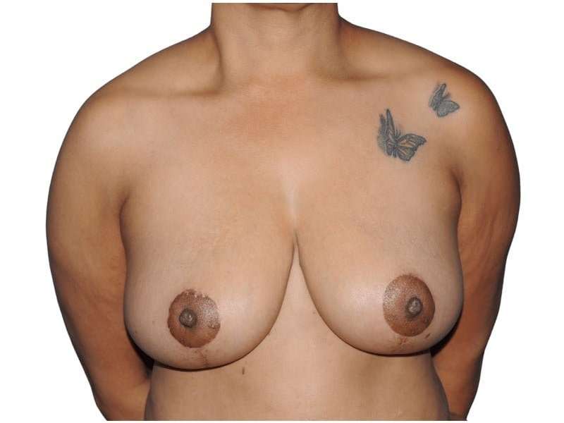 Mommy Makeover Before & After Patient #433
